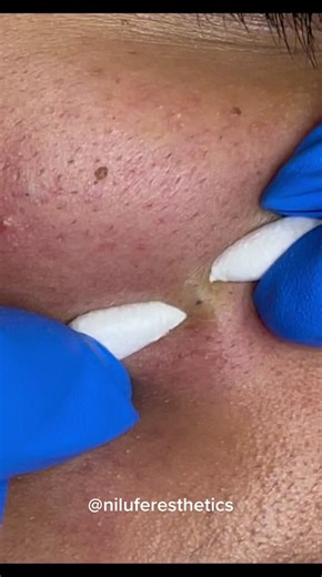 #extractions #torontifacials #blackheadextraction #pimplepopper2021 #pimplepopperaddict #extractionslovers #extractionsfacial #satisfying