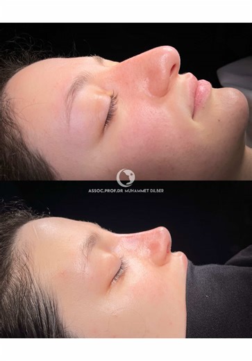 Thick Skin Rhinoplasty Transformation: Before & After