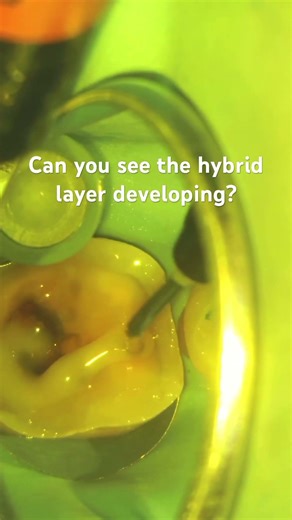 How to create a hybrid layer to dentin