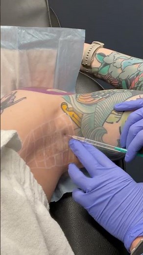 How BOTOX® Effectively Treats Hyperhidrosis