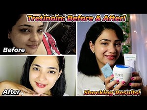 My Tretinoin Journey: Before & After Results (With Skincare Routine)