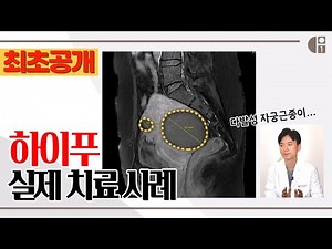 최초 공개! 하이푸 치료 실제 사례 BEST 3 | 자궁근종, 자궁선근증, 치료후기