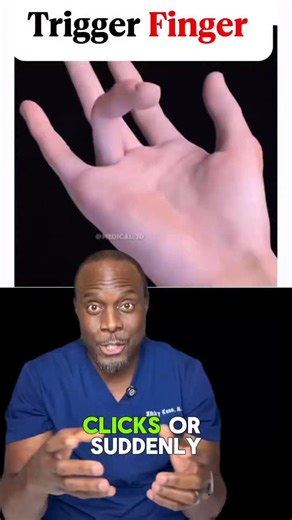 Zikky Kanu, M.D. on Instagram: "If your finger locks, clicks, or suddenly snaps straight, this might be trigger finger. It’s not a joint issue, it’s a tendon getting stuck in a tunnel that’s too tight. Let’s break it down. #TriggerFingerExplained #TendonHealth #OrthoFacts #HandPain #MedicalEducation Disclaimer: This content is for educational purposes only and should not be used as a substitute for professional medical advice, diagnosis, or care"