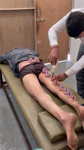 Dry cupping therapy for sciatica nerve pain