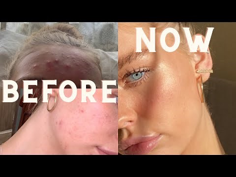 my accutane journey