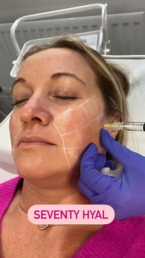 Seventy Hyal 2000 using the BAP technique 🧚🏻‍♀️ What’s your favourit...