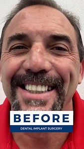 Transforming smiles is what we LOVE to do here at Nuvia Dental Implant Center, and we're proud to have helped our patient achieve their dream smile. 🤩🎉 #maketheworldsmile #dentalimplants #dental #implants #transformation #dentures #teeth #dentist #before #after #beforeandafter #positivelyunstoppable #health #asmr #trend #love #fyp #diy | Nuvia Dental Implant Center