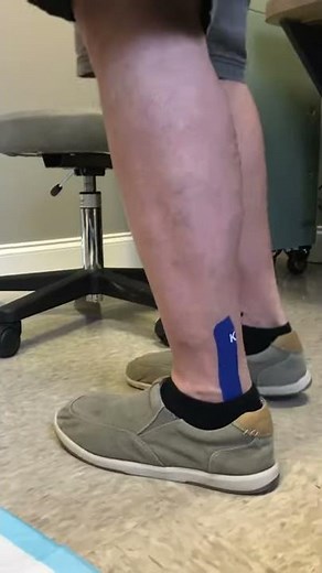 67 Days after heel spur removal and reattachment of Achilles with speed ridge