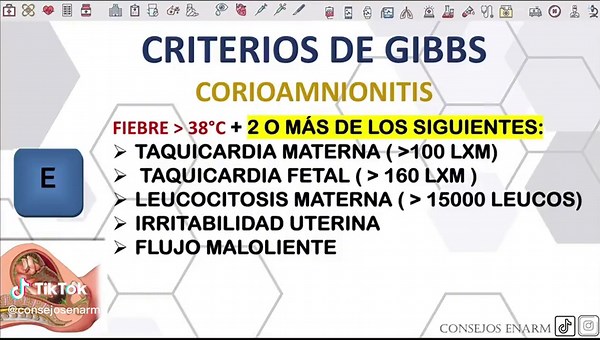 #enarm #corioamnioitis CRITERIOS DE GIBBS PARA CORIOAMNIONITIS