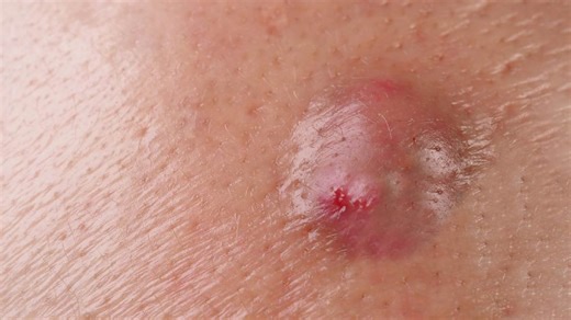 A Comprehensive Guide For Treating and Preventing Vaginal Boils: Here’s What You Need To Know