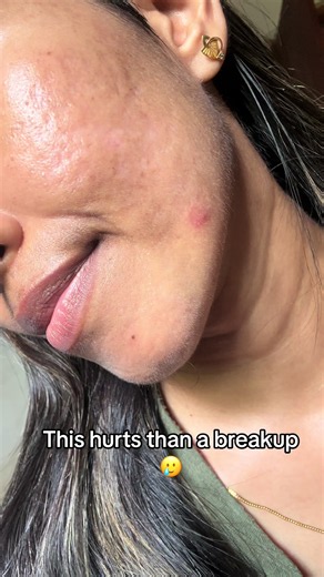 Accutane Pimple Struggle