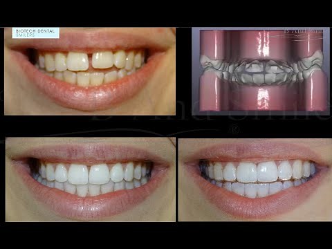 béance relative : 3 Mois d'orthodontie invisible Smilers Expert, ATP38 et blanchiment B And Smile