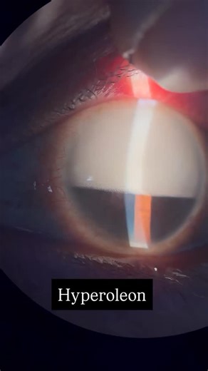 Ophthalmo_Mentor on Instagram: "An “inverted hypopyon (hyperoleon) ,” caused by emulsification of silicone oil used during vitreoretinal surgery, enters the anterior chamber of the eye. The emulsified silicone oil bubbles float in the aqueous and look like a layered hypopyon in the upper portion of the anterior chamber. Cr • @madforophthal #ophthalmology #ophthalmicphotography #ophthalmologistsofinstagram #ophthalmologistgram #ophthalmologist #ophthalexam #mbbs #mbbsstudent #neet #medicalstudent