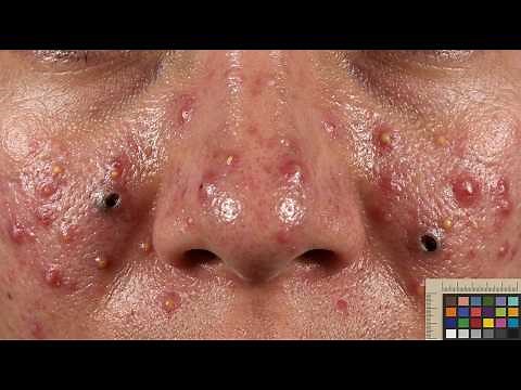 Loan Nguyen Acne Treatment - Satisfying Blackhead Extraction