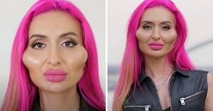 Model With 'World's Biggest Cheeks' Shows Appearance Prior To Transformation In Photograph