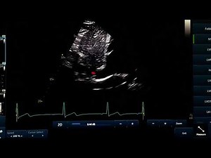 IVC view and measurment