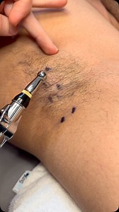 1.9M views · 3K reactions |  Dry needling for low back pain targets deep muscle knots and trigger points that contribute to tightness and limited movement. It helps reduce pain, improve mobility, and reset muscle function—fast.  #DryNeedling | Dr_kyleross | Facebook