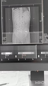 CT HBS contrast | CT Scan and MRI study