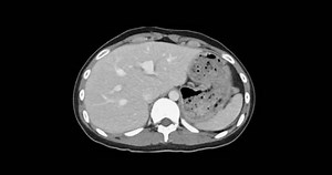 Ct Whole Abdomen Normal Study No Stock Footage Video (100% Royalty-free) 3713021215 | Shutterstock