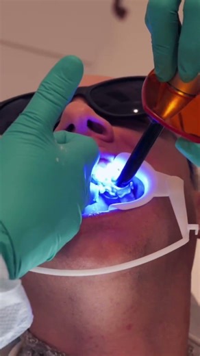 MARPE in action 🦷 #marpe #sleepapnea #skeletalexpansion