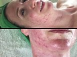 Woman shares her devastating battle with cystic acne