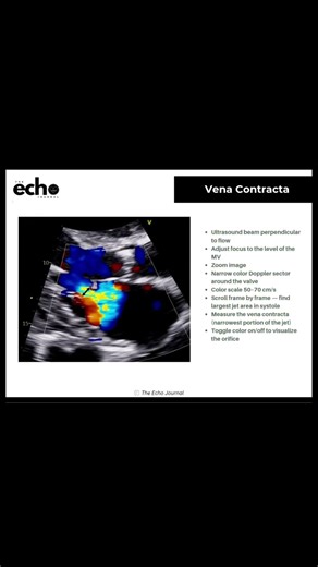 Vena Contracta on Echocardiography