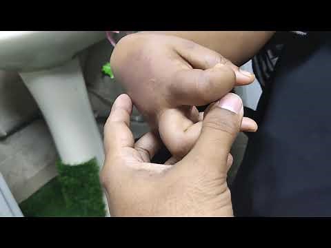 Acute Dystonic reaction (Drug induced)