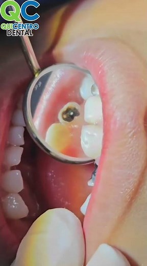 Do you know what a pulpectomy is?