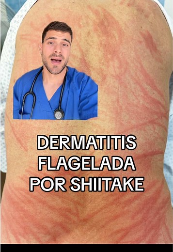 Dermatitis Flagelada por Consumo de Setas Shiitake