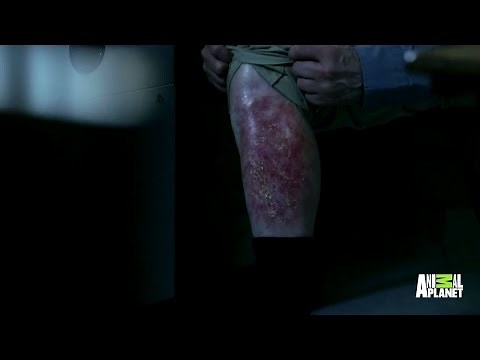 A Bloody, Pus-Filled Rash Goes from Bad to Worse