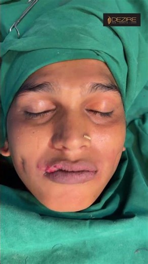 Dimple Creation | Dimple Result