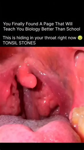 HEALTH | MEDICAL | BIOLOGY on Instagram: "Tonsil stones, also called tonsilloliths, are tiny but unpleasant lumps that form when food particles, dead cells, mucus, and bacteria get trapped in the small crevices (crypts) of the tonsils. Over time, this trapped material becomes a breeding ground for bacteria, especially odor-producing ones, which cause bad breath and a bad taste. Minerals like calcium from saliva then slowly deposit on this debris, making it harden into small stone-like formations