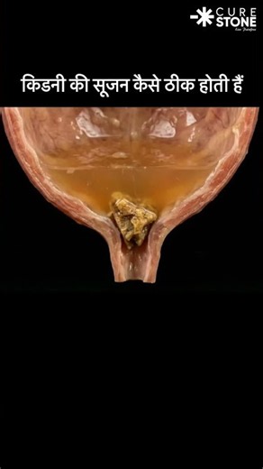 How hydronephrosis is treated in a kidney stone patient #urology