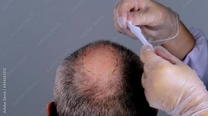 close-up trichologist treats patient, bald mature man with alopecia in hair growth clinic, anti-aging treatments for balding men. concept of hair transplant procedures for men, selective focus