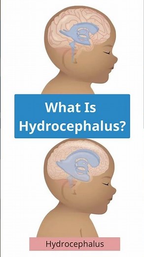 What Is Hydrocephalus? Explained for Nurses 🧠