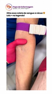 O procedimento de coleta de sangue a vácuo é uma técnica eficiente e higiênica utilizada para obter amostras de sangue para exames laboratoriais. Vamos entender como é feito: Preparação: O local da punção, geralmente o braço do paciente, é desinfetado e um torniquete é aplicado para facilitar a visualização e a palpação das veias 1. Punção Venosa: Uma agulha especial conectada a um suporte é inserida na veia do paciente. A agulha possui duas pontas, uma que entra na veia e outra que perfura o tu