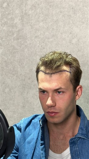 Hair Transplant in Turkey on Instagram: "Hair Transplant Process | Hair Transplant in Turkey @_yaroslav_toporkov_ #hairtransplant #hairtransplantturkey #пересадкаволос #пересадкаволосвтурции #transplantecapilar"