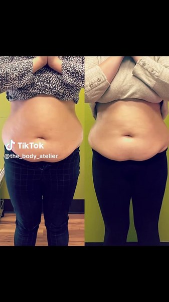 Benefits: ✨ Body Sculpting: Helps reduce stubborn fat, contour your shape, and boost confidence—non-invasive with no downtime. #Transform your body with our advanced body sculpting services! We specialize in non-invasive treatments using ultrasound cavitation to break down fat cells, radio frequency for skin tightening, and wood therapy to shape and tone your body. Our customized treatments help you achieve a slimmer, firmer, and more contoured appearance without the need for surgery. Perfect fo