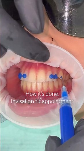 Invisalign fit appointment, including placing attachments 🙌 #Invisalign #orthodontist