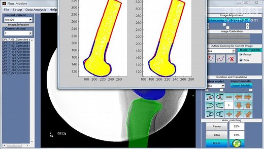 双平面荧光配准系统fluo_motion-膝关节股骨胫骨运动及髌骨轨迹追踪