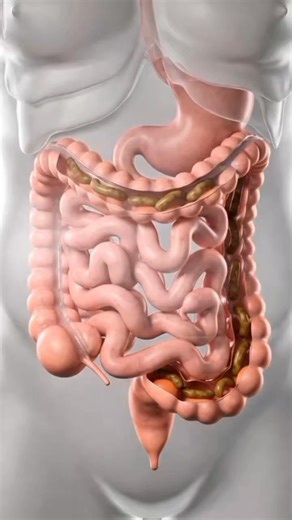 کولونیک اینرشیا (Colonic Inertia). کولونیک اینرشیا یک مشکل حرکتیِ (رودهٔ بزرگ) است که در آن روده به‌ درستی کار نمی‌کند و حرکت طبیعی مدفوع بسیار کند می‌شود. در این حالت، روده سالم به نظر می‌رسد، اما حرکت آن ضعیف و سست است. افراد مبتلا معمولاً دچار قبض شدید و طولانی‌ مدت می‌شوند که با دواهای معمول قبض هم خوب نمی‌ شود. احساس پُری شکم، نفخ، درد خفیف شکم، کم‌ شدن اشتها و گاهی سردرد از علایم شایع آن است. این مشکل بیشتر در خانم‌ ها و افرادی که مدت طولانی کم‌ تحرک هستند دیده می‌شود. علت دقیق کولونیک این