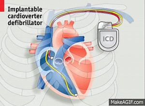 Videographic: Electric Beats - Pacemakers and the Human Heart on Make a GIF
