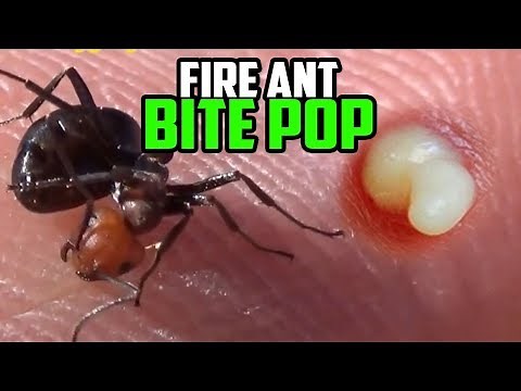 Fire Ant Bite Popped Under Microscope