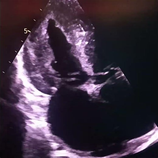 flail mitral valve leaflet.