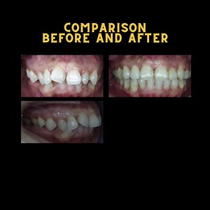 Patient initially had insufficient upper incisor showing upon smiling, severe crowding on upper arch, increase overjet and posterior overbite. After invisalign treatment, full height of upper incisor noted upon smiling, severe crowing on upper arch eliminated, increase overjet corrected and posterior overbite corrected. For more information: ☎️ Call us at 03 9212 0605 / 03 2284 5529 or 📲 WhatsApp 016 336 5529 or 💻 Send us a DM 😆 🖥 Visit http://imperialdsc.com #Imperial #ImperialDental #Imper