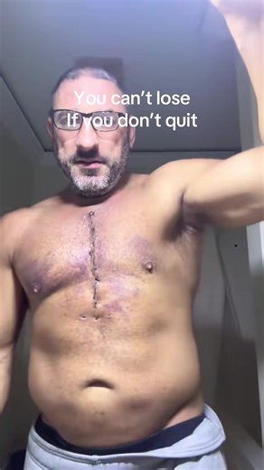 10-Week Recovery Journey After Heart Surgery