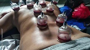 Cupping or Bekam Hijamah is traditional treatment. Bekam, islamic medicine ways. Removes dirty blood from skin cells for treating various diseases