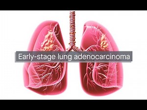 Early-stage lung adenocarcinoma: Pioneering insights from scRNA and scTCR integrated analysis