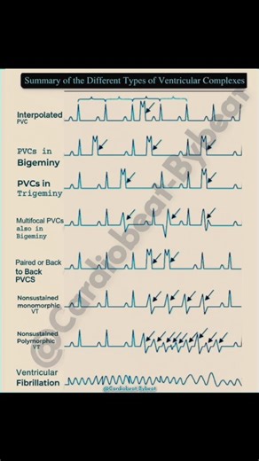 Abdallah Othman on Instagram: "Decoding Ventricular Complexes Key clinical entities: •Benign: Isolated PVCs (Bigeminy/Trigeminy) •Concerning: Complex Ectopy, NSVT •Critical: Ventricular Fibrillation → Immediate Defibrillation Recognize the spectrum. #HeartRhythm #ECG #Cardiology #PVCs"