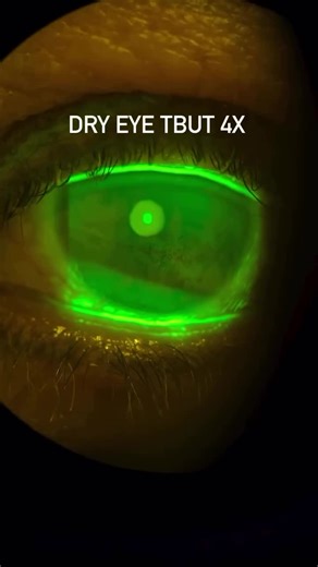 You’re looking at a real-time tear break-up time (TBUT) test—only accelerated so you can literally see the tear film evaporating.As the seconds pass, the tear layer thins, destabilizes, and breaks…… | Mohammed Alharbi , OD